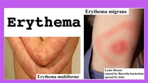 Erythema Marginatum Vs Erythema Multiforme