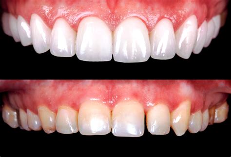 Mejor Tratamiento De Carillas Dentales En Barcelona Rodium