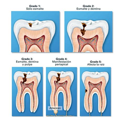 Caries Dental Conozca Los Síntomas Y Tratamientos Para Curarlas Directorio Odontológico