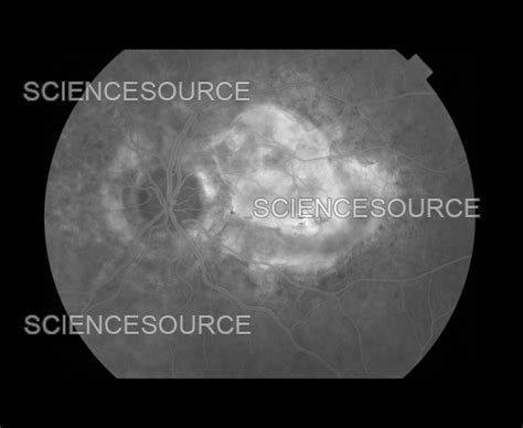 Choroidal Neovascular Membrane Diagram