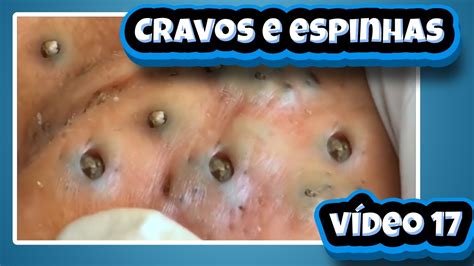 Videos Tirando Cravos E Espinhas Gigantes Youtube