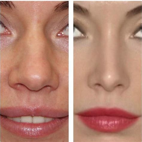 Rhinoplasty Bulbous Nose Reduction Is One Of The Most Commonly Requested Changes That Patients ...