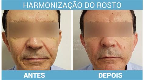 Harmonização Facial Masculina Fotos Como Funciona E 6 Dicas