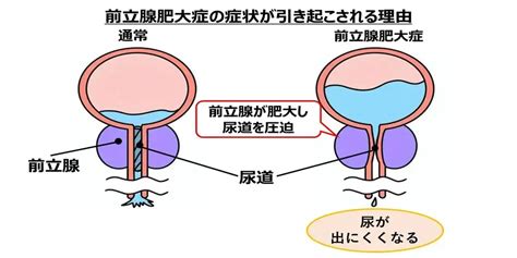 前立腺肥大症とed勃起不全の関係性は？原因・症状・治療・予防方法を解説 メデマートコラム