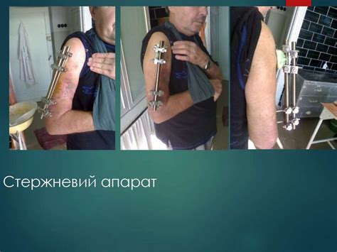 Закриті і відкриті переломи. Сучасні методи Лікування переломів ...