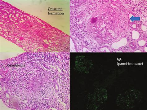 Two Cases Of Idiopathic Granulomatous Interstitial Nephritis Figure 2 Download Scientific