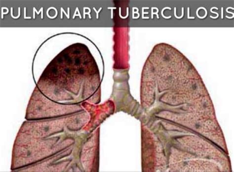 Tuberculosis Flashcards Quizlet