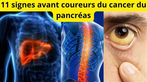 11 signes avant coureurs du cancer du pancréas YouTube