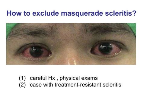 Scleritis Professor 1001030 Ppt