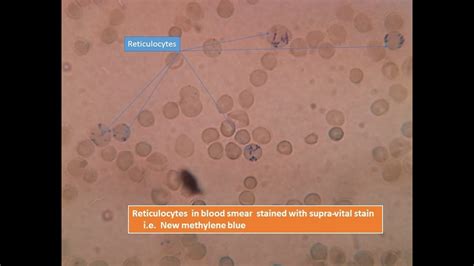 Reticulocytes In Supravital Stain Youtube