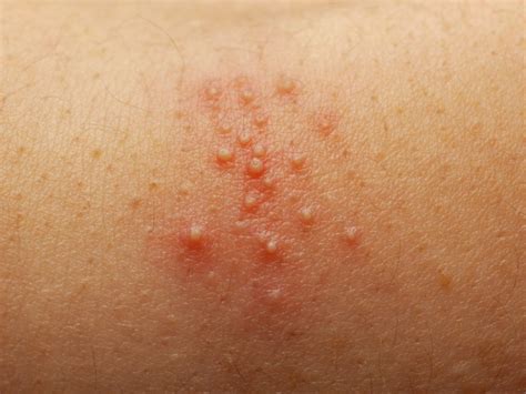 How To Treat Pityrosporum Folliculitis Fungal Acne Antifungal Cream