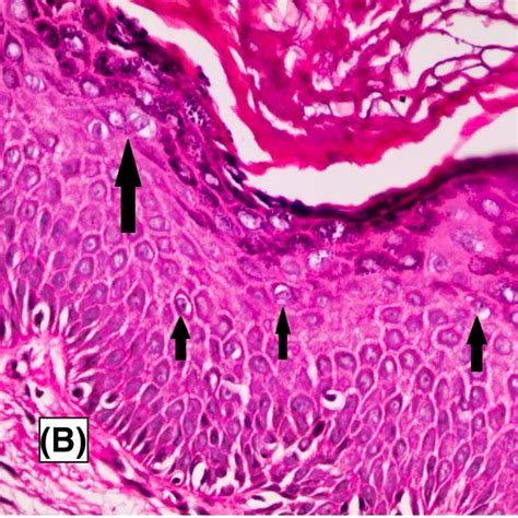 Multiple Reddish‐brown Papules And Plaques On The Genital Area Trunk Download Scientific