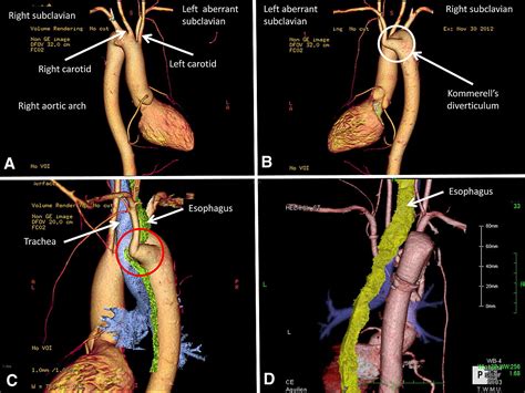 Surgical Strategy For Kommerell S Diverticulum Total Arch Replacement