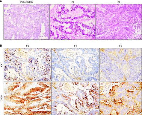 Histologic Evaluation Of A Patient Derived Colorectal Cancer Liver