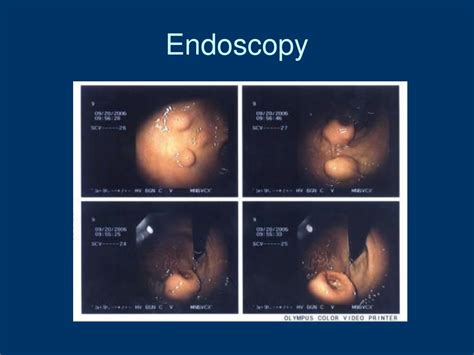 Ppt Gastrointestinal Stromal Tumours Gist Powerpoint Presentation Free Download Id 4751841