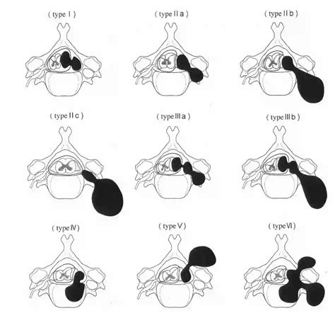 Asazuma Klassifikation Ars Neurochirurgica