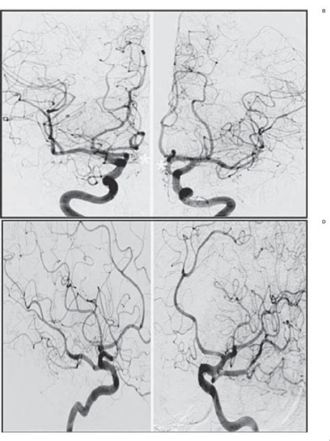 Figure From Endovascular Exclusion Of The Anterior Communicating