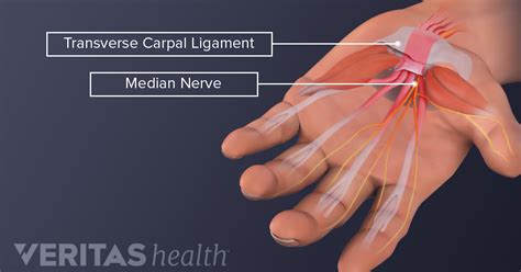 Is My Hand Pain from Carpal Tunnel Syndrome or Something Else?