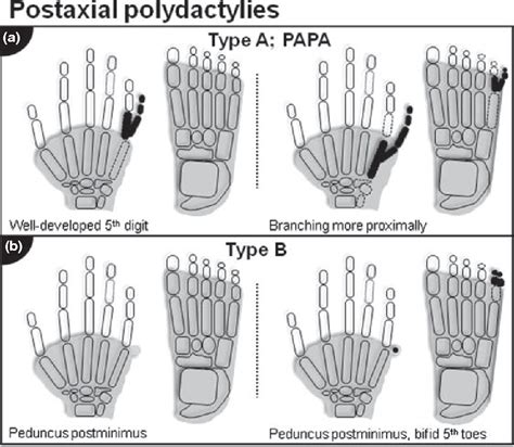 Polydactyly: phenotypes, genetics and classification. - Semantic Scholar