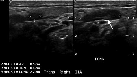 Lymphadenitis and Lymphadenopathy - Internet Book Of MSK Ultrasound