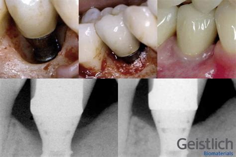 Peri implantite prevenção e 2 tratamentos para implante