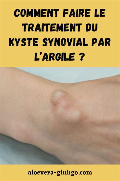 Comment Faire Le Traitement Du Kyste Synovial Par Largile Artofit