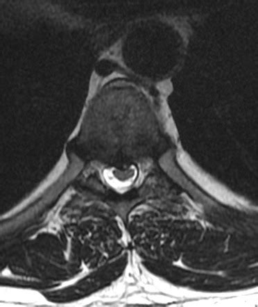 Radiology Quiz 83269 Radiopaedia Org Playlist 9 MRI Common Spine