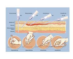 injection angles | Nursing tips, Nursing programs, Subcutaneous tissue