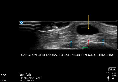 Ganglion Cyst Knee Ultrasound