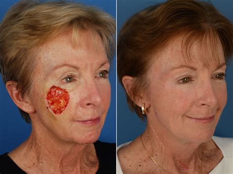 Skin Cancer Reconstruction Photos Naples Fl Patient 12033