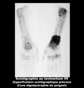 Algodystrophie Dystrophie Sympathique R Flexe Causes Sympt Mes