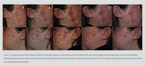 Figure 1 From Multiple Drug Regimen Refractory RosaiDorfmanDestombes