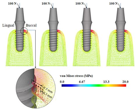 The Von Mises Stresses In The Interfacial Bone Around The Implants With Download Scientific