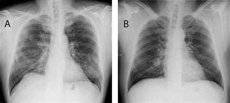 A Chest X Ray Showing Right Hilar Enlargement A Subsequent Ct Scan Download Scientific