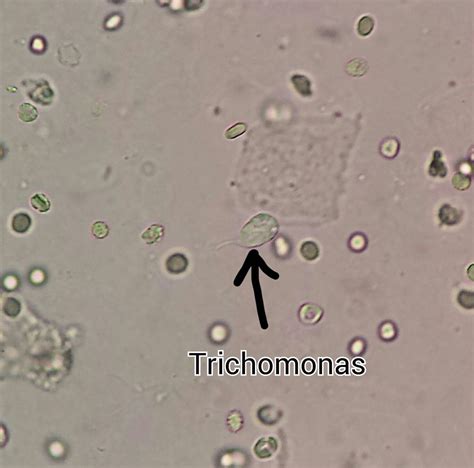 Trichomonas Vaginalis In Urine Google Search Medical Laboratory