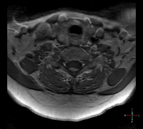 Spinal Meningioma Image Radiopaedia Org