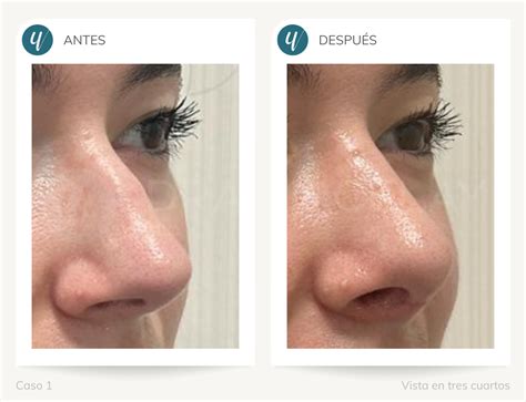 Rinoplastia Ultrasónica Qué Es Beneficios Y Ventajas