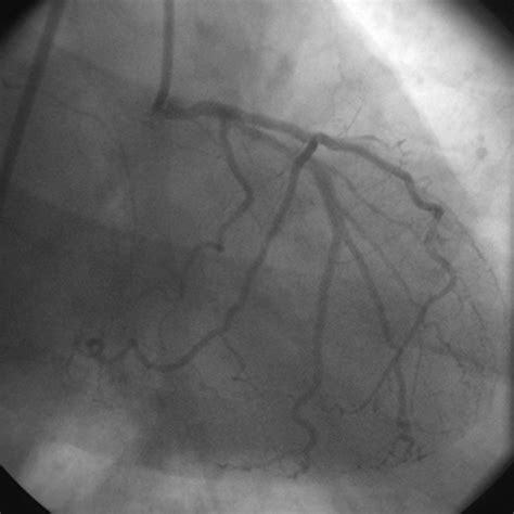 Super Dominant Left Anterior Descending Artery With Origin Of Both