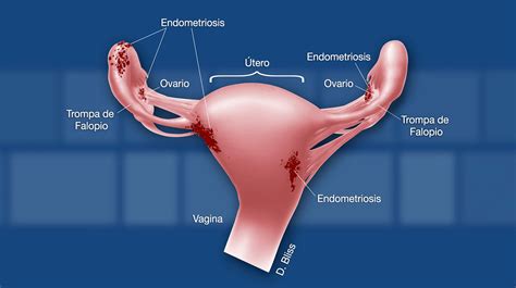 Sobre la endometriosis NICHD Español