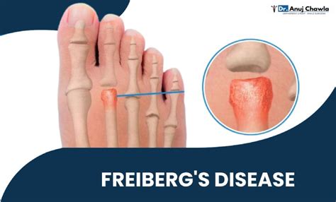 Freibergs Disease Dont Ignore The Foot Pain Of Your Child