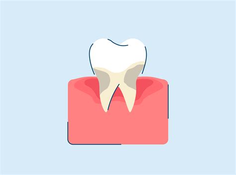 Periodontitis Symptoms Causes And Treatments
