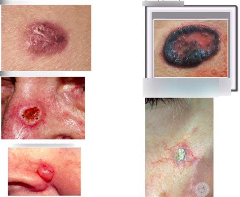 Carcinoma Basocelular Diagram Quizlet