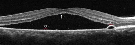 Serous Retinal Detachment Oct