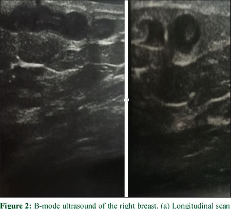 Figure 2 From Mondor S Disease Of The Breast In A Nigerian Woman Previously Treated For Invasive