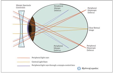 Myopia Control What It Is And How To Talk To Your Patients About It