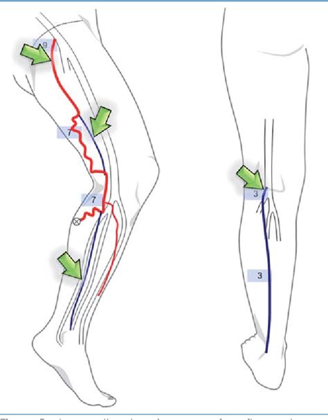 Figure From Duplex Ultrasound In The Assessment Of Lower Extremity