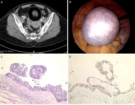 A Abdominopelvic Computed Tomography Scan Showing An Cm