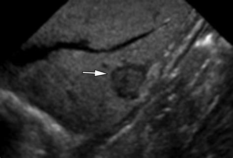 Pancreatic Neuroendocrine Neoplasms 2020 Update On Pathologic And