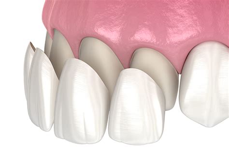 Composite Teeth Bonding And Filling Everything You Need To Know