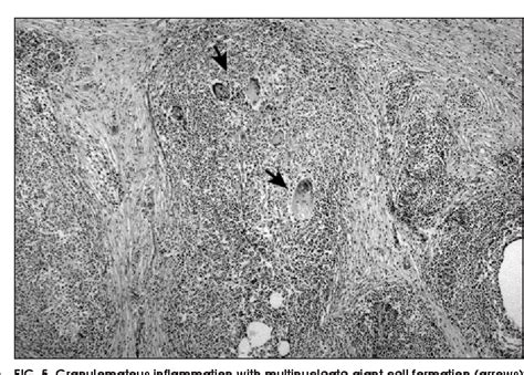 Pdf Granulomatous Mastitis Including Breast Tuberculosis And